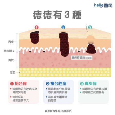 臉部黑痣|痣變大、痣多或長毛會變皮膚癌？認識痣的形成與原因